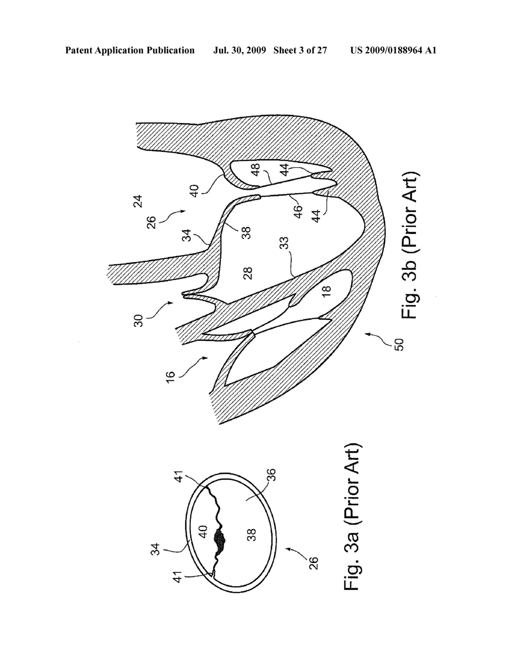 MEMBRANE AUGMENTATION, SUCH AS OF FOR TREATMENT OF CARDIAC VALVES, AND FASTENING DEVICES FOR MEMBRANE AUGMENTATION - diagram, schematic, and image 04