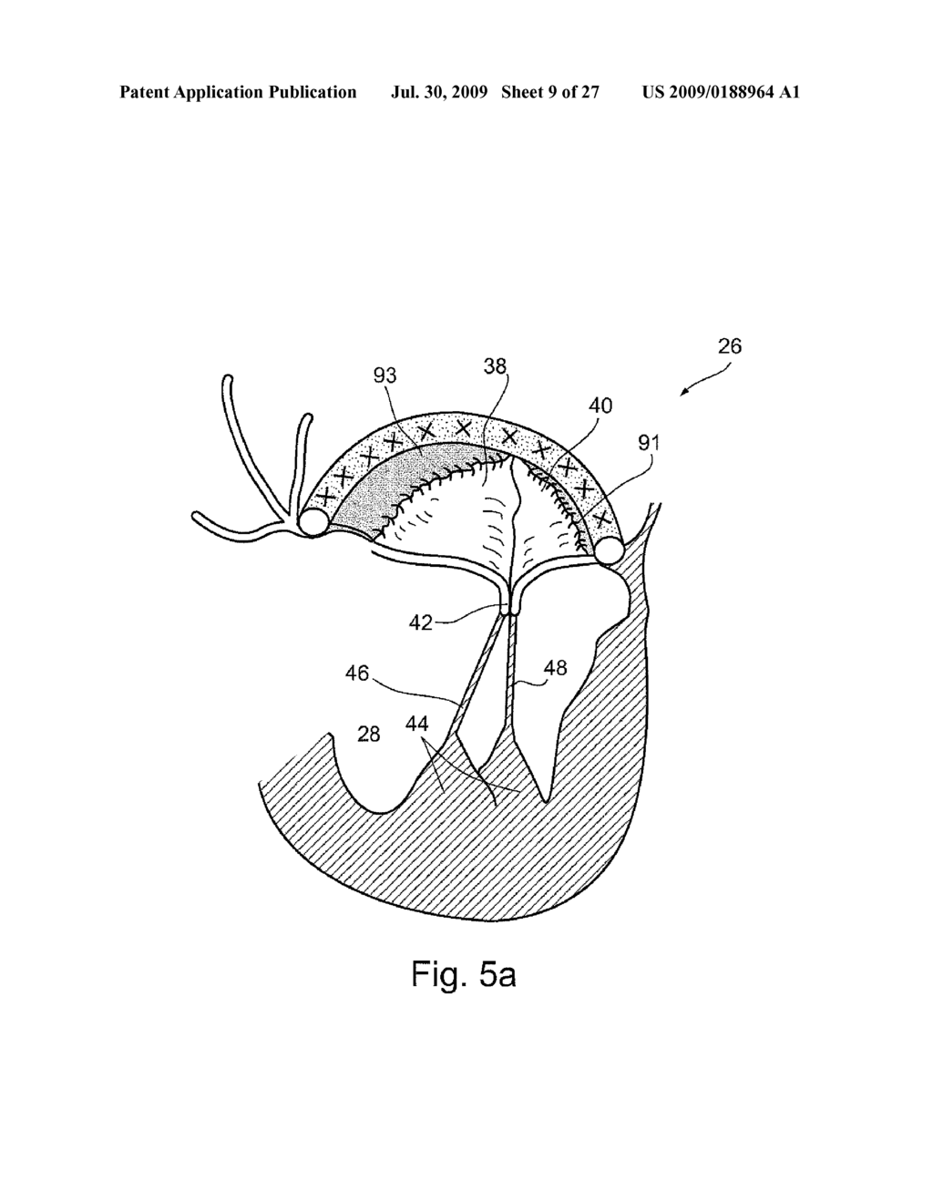 MEMBRANE AUGMENTATION, SUCH AS OF FOR TREATMENT OF CARDIAC VALVES, AND FASTENING DEVICES FOR MEMBRANE AUGMENTATION - diagram, schematic, and image 10