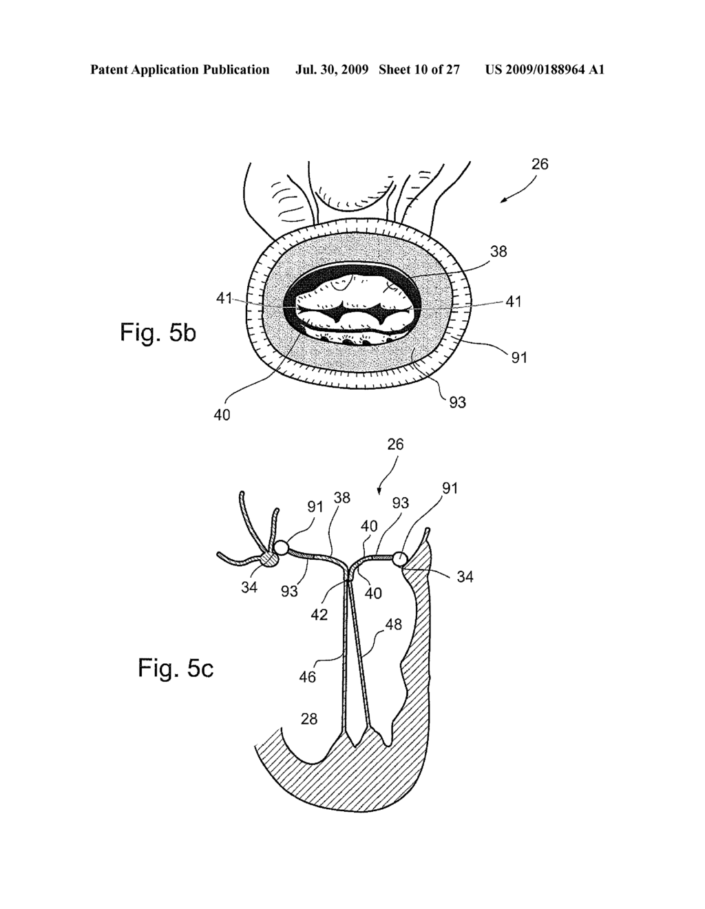 MEMBRANE AUGMENTATION, SUCH AS OF FOR TREATMENT OF CARDIAC VALVES, AND FASTENING DEVICES FOR MEMBRANE AUGMENTATION - diagram, schematic, and image 11