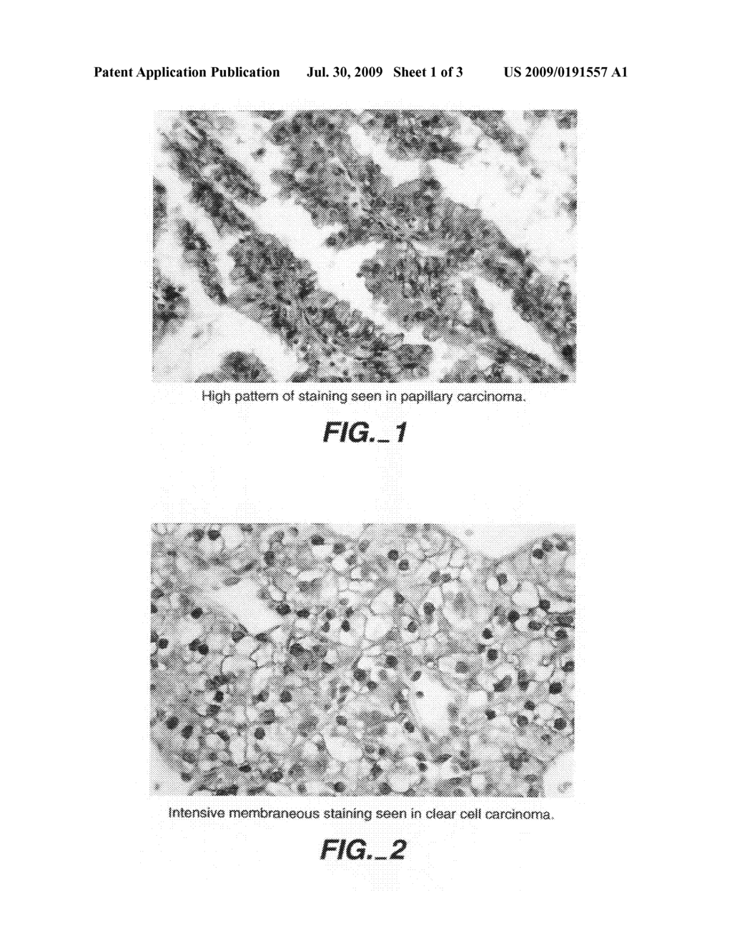 MN/CA IX/CA9 and renal cancer prognosis - diagram, schematic, and image 02