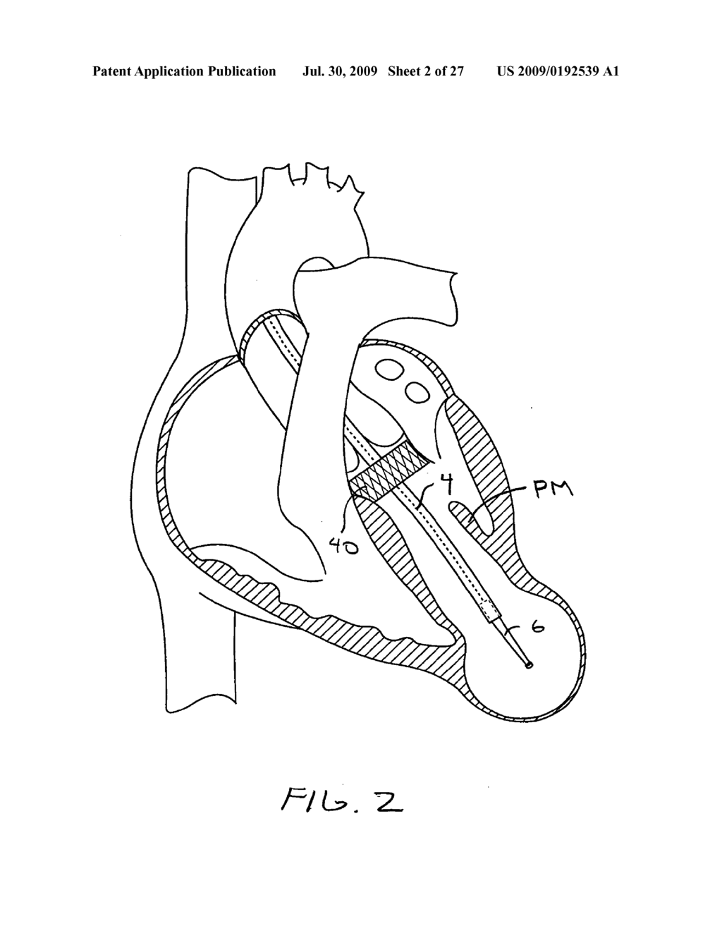 Methods and Devices for altering blood flow through the left ventricle - diagram, schematic, and image 03