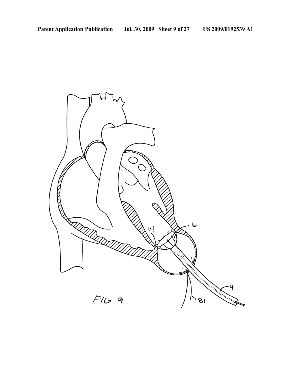 Methods and Devices for altering blood flow through the left ventricle - diagram, schematic, and image 10