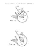 Methods and Devices for altering blood flow through the left ventricle diagram and image