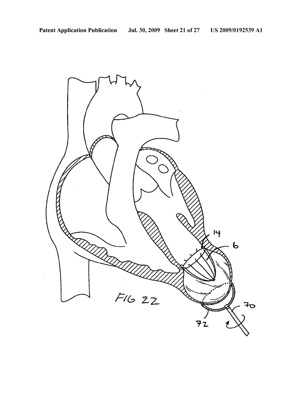 Methods and Devices for altering blood flow through the left ventricle - diagram, schematic, and image 22