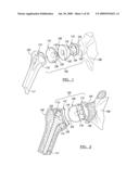 Shoulder Implant Assembly diagram and image