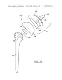 Shoulder Implant Assembly diagram and image