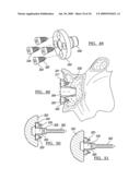 Shoulder Implant Assembly diagram and image