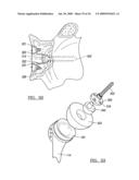 Shoulder Implant Assembly diagram and image