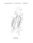 METHODS AND SYSTEMS FOR ENDOVASCULAR ANEURYSM TREATMENT diagram and image