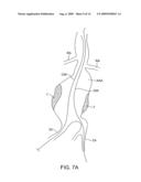 METHODS AND SYSTEMS FOR ENDOVASCULAR ANEURYSM TREATMENT diagram and image