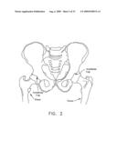 METHOD AND APPARATUS FOR RE-ATTACHING THE LABRUM OF A HIP JOINT diagram and image