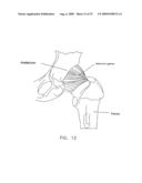 METHOD AND APPARATUS FOR RE-ATTACHING THE LABRUM OF A HIP JOINT diagram and image