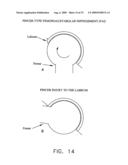 METHOD AND APPARATUS FOR RE-ATTACHING THE LABRUM OF A HIP JOINT diagram and image