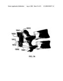 BONE TISSUE FIXATION DEVICE AND METHOD diagram and image