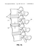 SPINAL IMPLANT AND METHOD FOR RESTRICTING SPINAL FLEXION diagram and image