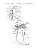 SPINAL IMPLANT AND METHOD FOR RESTRICTING SPINAL FLEXION diagram and image