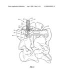 BONE SCREW diagram and image