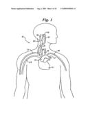 BAROREFLEX ACTIVATION FOR ARRHYTHMIA TREATMENT diagram and image