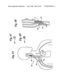 BAROREFLEX ACTIVATION FOR ARRHYTHMIA TREATMENT diagram and image