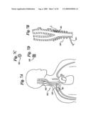 BAROREFLEX ACTIVATION FOR ARRHYTHMIA TREATMENT diagram and image