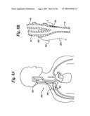 BAROREFLEX ACTIVATION FOR ARRHYTHMIA TREATMENT diagram and image