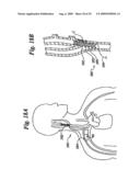 BAROREFLEX ACTIVATION FOR ARRHYTHMIA TREATMENT diagram and image