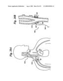 BAROREFLEX ACTIVATION FOR ARRHYTHMIA TREATMENT diagram and image