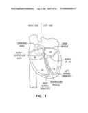 METHOD AND APPARATUS FOR OPTIMIZING VENTRICULAR SYNCHRONY DURING DDD RESYNCHRONIZATION THERAPY USING ADJUSTABLE ATRIO-VENTRICULAR DELAYS diagram and image