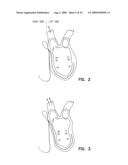 METHOD AND APPARATUS FOR OPTIMIZING VENTRICULAR SYNCHRONY DURING DDD RESYNCHRONIZATION THERAPY USING ADJUSTABLE ATRIO-VENTRICULAR DELAYS diagram and image