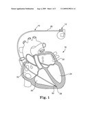 LEAD WITH MRI COMPATIBLE DESIGN FEATURES diagram and image