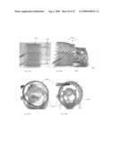 Vascular Stents, Methods of Use and Methods of Manufacture diagram and image