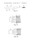 Delivery Systems and Methods of Implantation for Prosthetic Heart Valves diagram and image