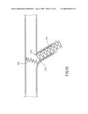 Assembly for the Treatment of Bifurcations diagram and image