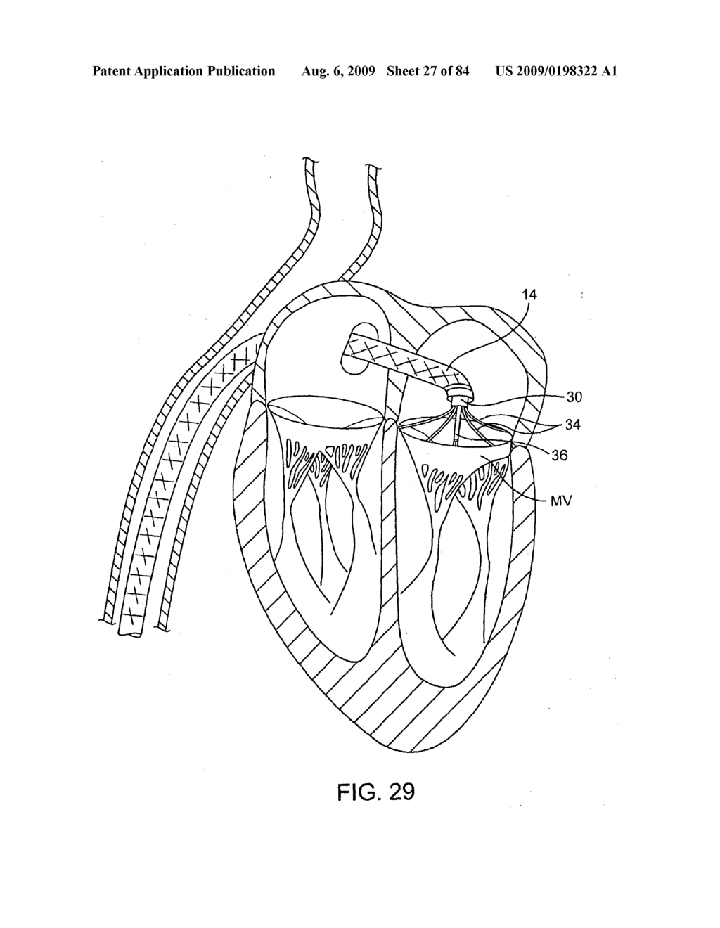 Methods And Apparatus For Cardiac Valve Repair - diagram, schematic, and image 28