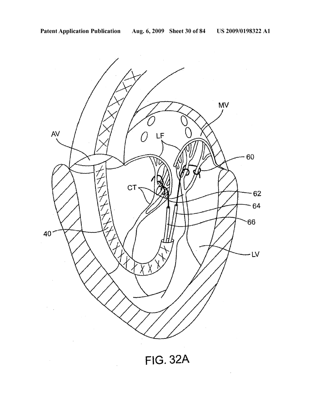 Methods And Apparatus For Cardiac Valve Repair - diagram, schematic, and image 31