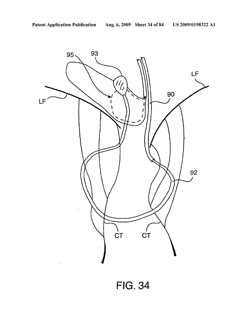 Methods And Apparatus For Cardiac Valve Repair - diagram, schematic, and image 35