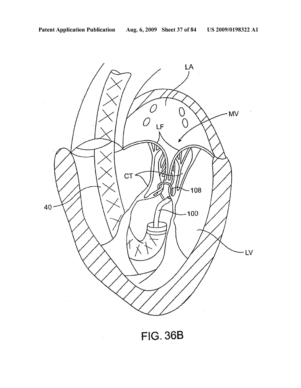 Methods And Apparatus For Cardiac Valve Repair - diagram, schematic, and image 38