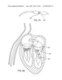 Methods And Apparatus For Cardiac Valve Repair diagram and image
