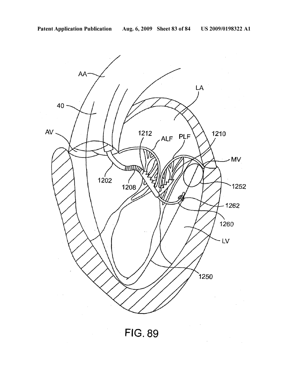 Methods And Apparatus For Cardiac Valve Repair - diagram, schematic, and image 84