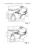 Ossicular Prosthesis Having Helical Coil diagram and image