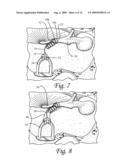 Ossicular Prosthesis Having Helical Coil diagram and image