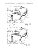Ossicular Prosthesis Having Helical Coil diagram and image