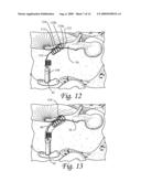 Ossicular Prosthesis Having Helical Coil diagram and image