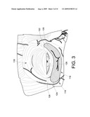 INFRA-ORBITAL IMPLANT diagram and image