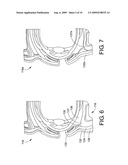 INFRA-ORBITAL IMPLANT diagram and image