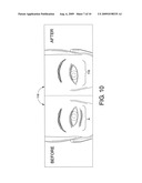 INFRA-ORBITAL IMPLANT diagram and image