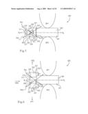 MEDICAL IMPLANTS AND METHODS diagram and image