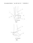 BONE PROSTHESIS diagram and image