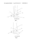 BONE PROSTHESIS diagram and image