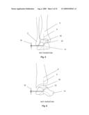 BONE PROSTHESIS diagram and image